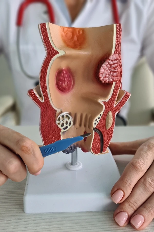 Fisura anal Cirugía de Fístula Anal en León