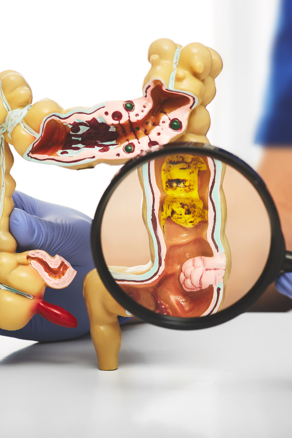 cirugia de fistula anal Servicios de Gastroenterología en Hospital Muguerza