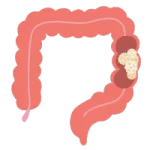 Cirugía Gastrointestinal de Urgencia en León