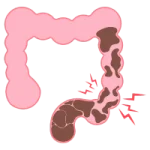 Cirugía Gastrointestinal de Urgencia en León
