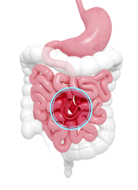 Intestino Perforado en León